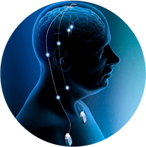 Implante de Estimulação Cerebral para Dor