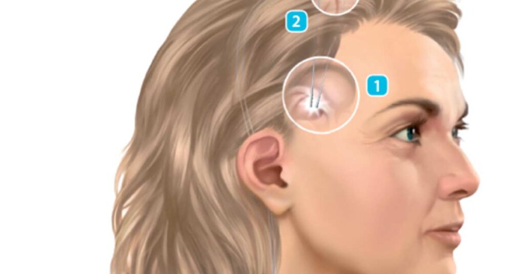 Como Funciona o DBS para Parkinson: Benefícios e Considerações